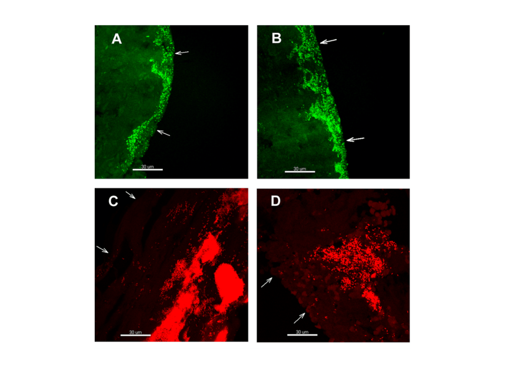 Bacterial Biofilm Underneath the Wound Bed